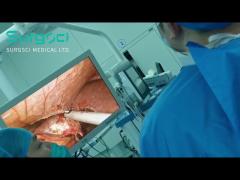 Ultrasonic Scalpel Used In Laparoscopic Resection Of Sigmoid Nodules And Partial Liver Tumors