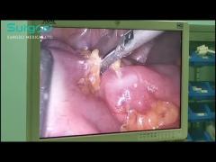 Ultrasonic Scalpel Application | Rectal Tumor Resection