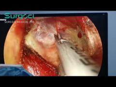 Ultrasonic Scalpel in Use during Thyroidectomy Surgery