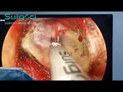 Utilizing SurgSci‘s Ultrasonic Scalpel in Thyroidectomy Procedures | Surgsci
