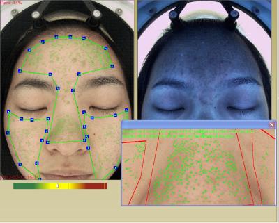 Chine La couche portative de derme de cosmétique d'analyse de peau et de thérapeute de peau détectent à vendre