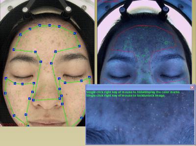 China Capa portátil médica del dermis del terapeuta del analizador de la piel 10 años de experiencia en venta