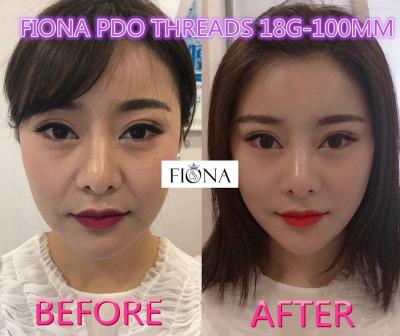 China Fiona PDO And PCL Thread , 38mm Face Lift PDO Thread for sale