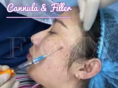 Cannula and Filler