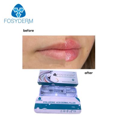 中国 Fosydermの唇の強化のための皮膚唇の注入口1mlのHyaluronic酸の注入 販売のため