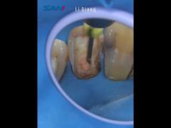 Dental Rotary File For Root Canal Retreatment 04/25, 04/30