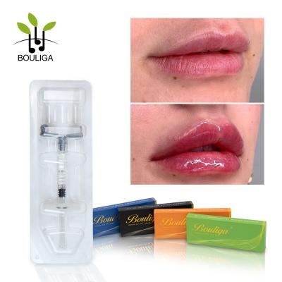 China Long Lasting Crosslinked hyaluronic acid Dermal  Filler For Lips Enchance for sale