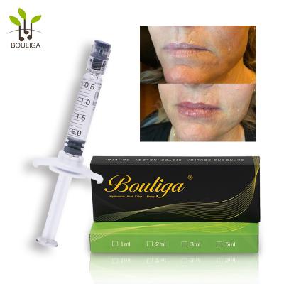 China Tratamiento facial ácido hialurónico del llenador de Chin No Wrinkles Cross Linked inyectable en venta