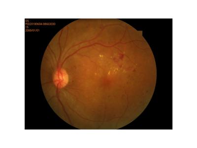 중국 망막 이미지화 디지털 안저촬영기 작은 학생 모드 고해상도 판매용