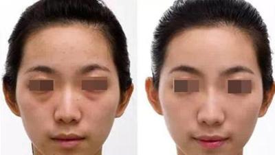 China Factory Supply Good Price High Quality Hyaluronic Acid Dermal Filler for sale