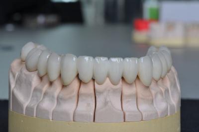 China Pure Titanium PFM dental bridge for sale