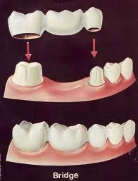 China Zirconia Temporary Crowns And Bridges With 100% Biocompatible CAD / CAM For Teeth Cosmetic for sale