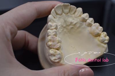 China Effective E.Max / Composite Inlays And Onlays For Repair Damaged Or Decayed Teeth for sale