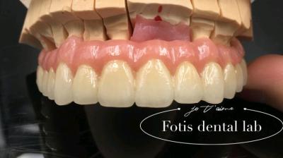 China Restauración confiable PFM coronas dentales de porcelana fundida a la corona de metal personalizada en venta