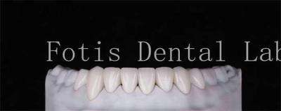 China Alta Durabilidade Veneers Dentes de aparência natural 0,3 mm-0,5 mm espessura à venda