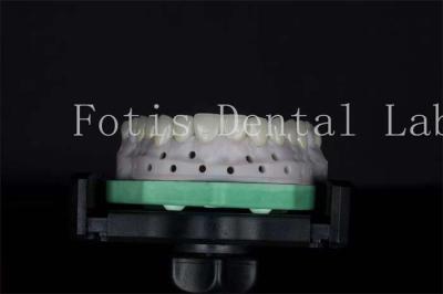 China Veneers de laboratório dentário de alta resistência personalizáveis para sorrisos naturais à venda