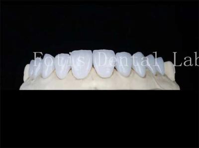 China Veneers de porcelana natural personalizados Veneers de laboratório dentário Resistente a manchas à venda