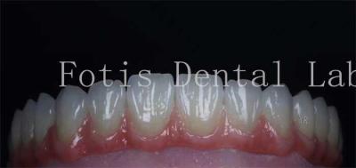 China Smooth Surface Cosmetic Tooth Coverings Natural Porcelain Veneers Customizable for sale