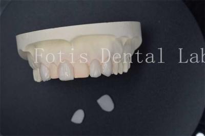 China Carillas de laboratorio dentales artificiales personalizadas con resistencia a manchas superior en venta