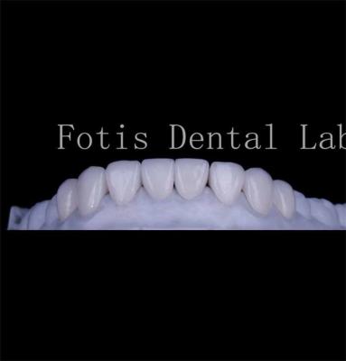 Chine Durabilité de la texture lisse Les dents couvrent les facettes Les facettes dentaires naturelles à vendre