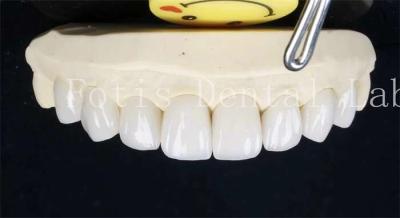 Cina 0.3-0.5mm denti in ceramica laminata vene false denti con cemento adesivo in vendita