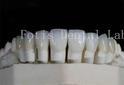 China Polished Dental Laminate Veneers High Translucency For Natural Looking Smiles for sale