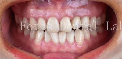 Китай Косметическая стоматология Зубные фарфоровые фанеры с высокой стойкостью к пятнам продается