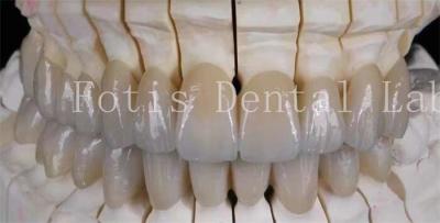 China Natural-Looking Smile Prosthetic Porcelain Laminate Veneers Smooth Surface for sale