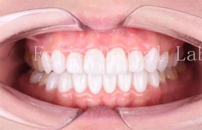 China Laminado Dental de Alta Translucidez Veneers Durabilidade Durabilidade Polido acabamento à venda