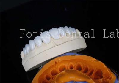 China Porcelain Dental Lab Veneers Bonding Cement For Long Lasting Restorations for sale