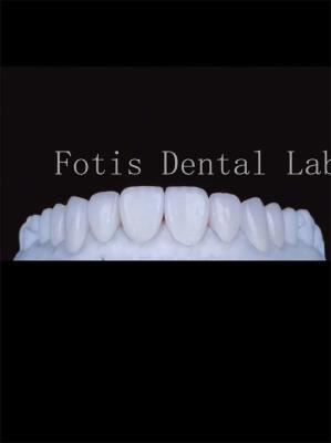 China High Translucency Porcelain Tooth Veneers Enhance Your Smile Naturally for sale