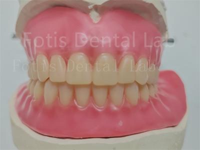 Chine Prothèse dentaire entièrement acrylique personnalisée à prix abordable avec dents Ivoclar facile à utiliser à vendre