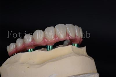 China Advanced Full Chewing Ability Restoration Implant Procedure for Low Bone Density Patients for sale