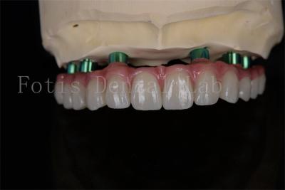 China Zirconia All-on-4 Implant Procedure Same Day Recovery Minimal Follow Up Needed for sale