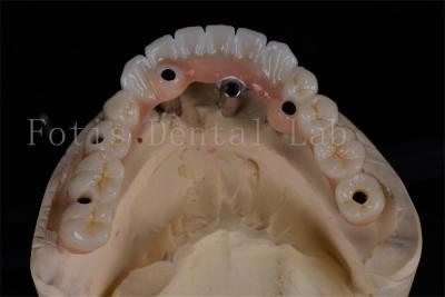China Success Rate All-on-4 Implant Dentures Same Day Procedure Affordable Full Chewing Restoration for sale