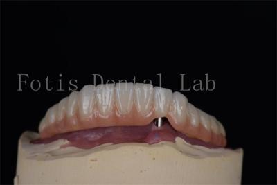 China Implantes dentales de aspecto natural de titanio o zirconio Procedimiento mínimamente invasivo fácil de limpiar en venta