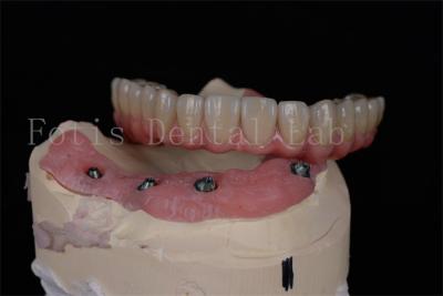 China Customizable All On 4 All On 6 Dental Implants For Complete Oral Rehabilitation for sale
