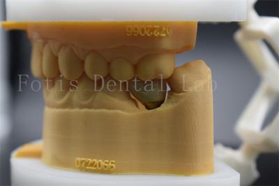 China Long Lasting Polished Dental Lab Crowns Precision Fit Comfort For Patients for sale