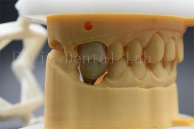 China Customizable Dental Implant Abutment Crown Comfortable For Patients for sale