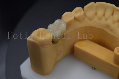 Китай Удобные и долговечные короны для зубных имплантатов для восстановления недостающих зубов продается