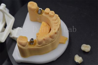中国 簡単に置くジルコニア 歯冠 歯用のチタン 冠 オーダーメイド 販売のため