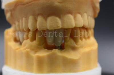 China Custom Made Dental Implant Crown Precision Fit For Missing Teeth for sale