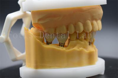 China Coroa dental de titânio de precisão para implante dental fácil de limpar e manter à venda
