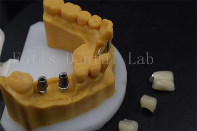 Chine Couronne d'implant dentaire de haute durabilité facile à régler à vendre