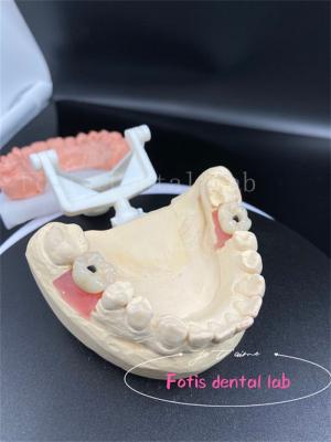 China Coronas dentales de la boca completa de ajuste de precisión Coronas dentales falsas de fácil colocación en venta