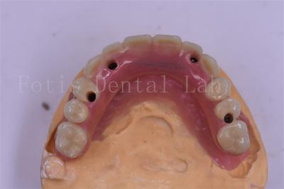 China Implante dental de titanio con corona dental de precisión en venta