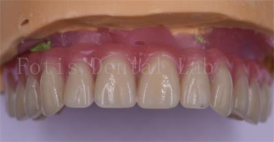 China Patient Comfort Custom Dental Crowns Polished Titanium/Zirconia/PFM Implant Crown for sale