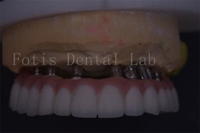 China Coronas dentales de plata personalizables de precisión adecuadas para una restauración cómoda en venta