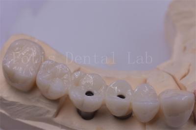 China Coronas dentales de titanio / zirconio de plata pulida para dientes faltantes en venta
