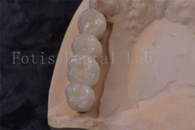 China Precision Fit Zirconia Tooth Crown Implant PFM Crown Easy To Clean for sale
